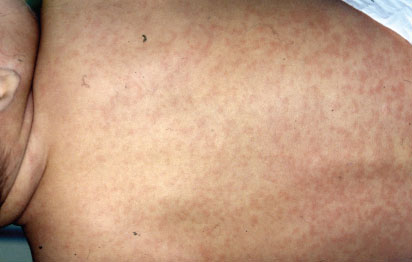 Common Childhood Skin Problems Slideshow - WebMD