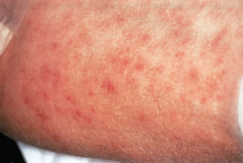House Call Doctor : When Should You Worry About a Rash ...