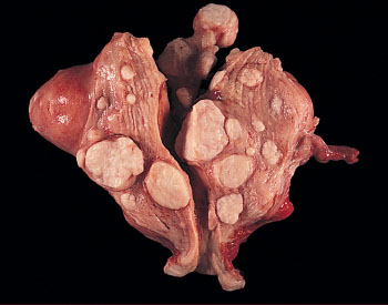 Pathology Outlines - Cutaneous leiomyoma